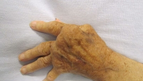 Scorpion venom stops rheumatoid arthritis from progressing, study finds